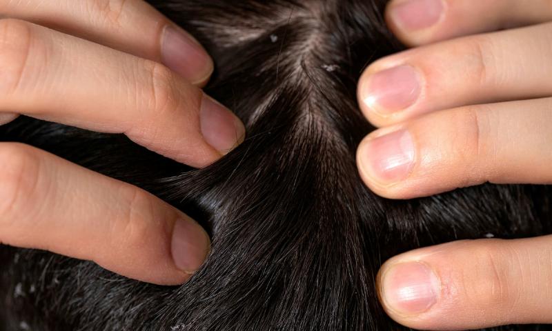 Tiêu Chí Chọn Dầu Gội Trị Gàu
