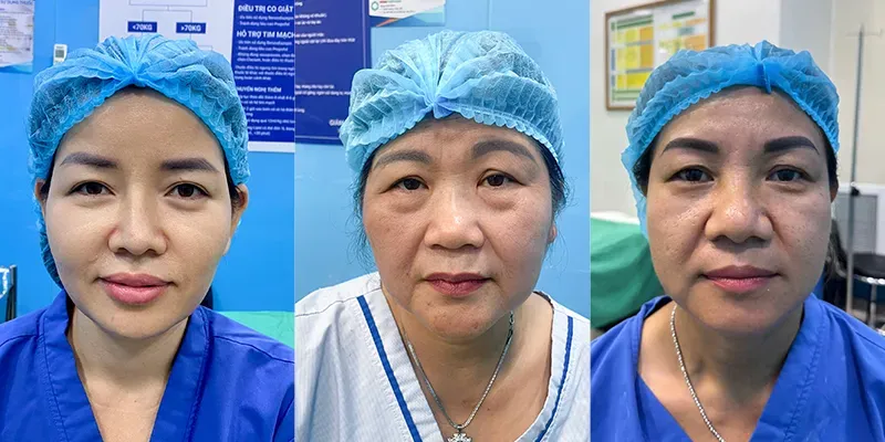 Các phương pháp nâng cung chân mày phổ biến