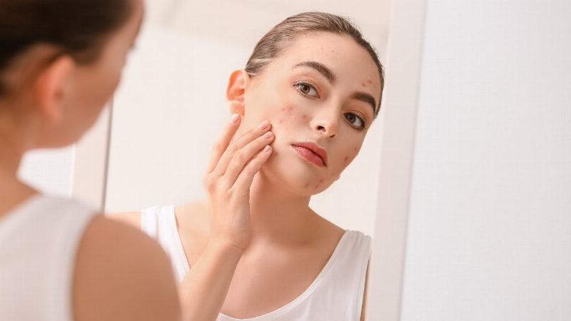 Cách chọn kem chấm mụn phù hợp