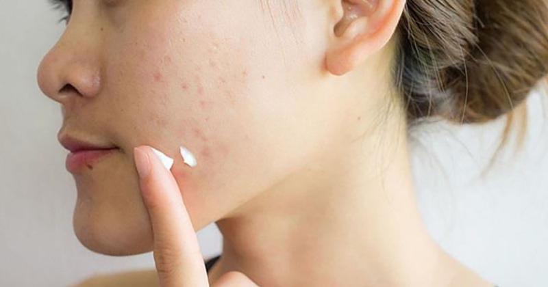 Chọn kem chấm mụn cho da dầu mụn