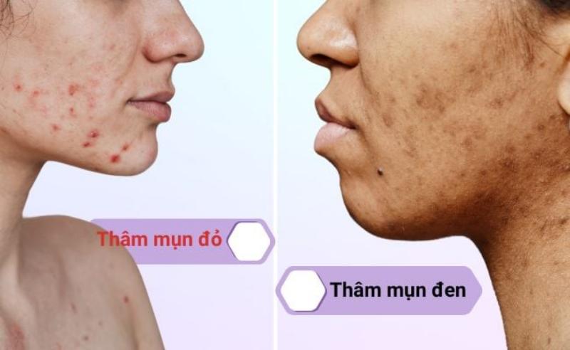 nhung-loi-lam-thuong-gap-khi-tri-tham-mun