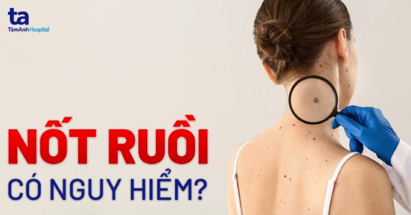 thay-doi-mau-sac-va-kich-thuoc-not-ruoi