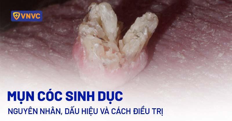 cac-loai-mun-o-vung-kin-mun-coc