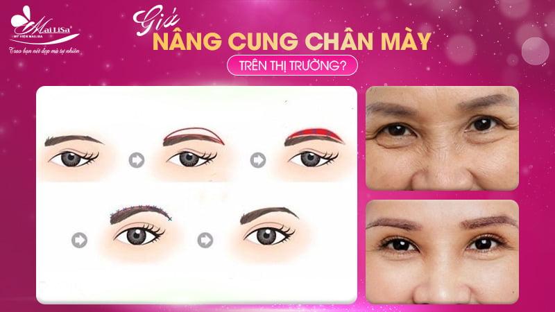 Bảng giá nâng cung chân mày tại các cơ sở thẩm mỹ