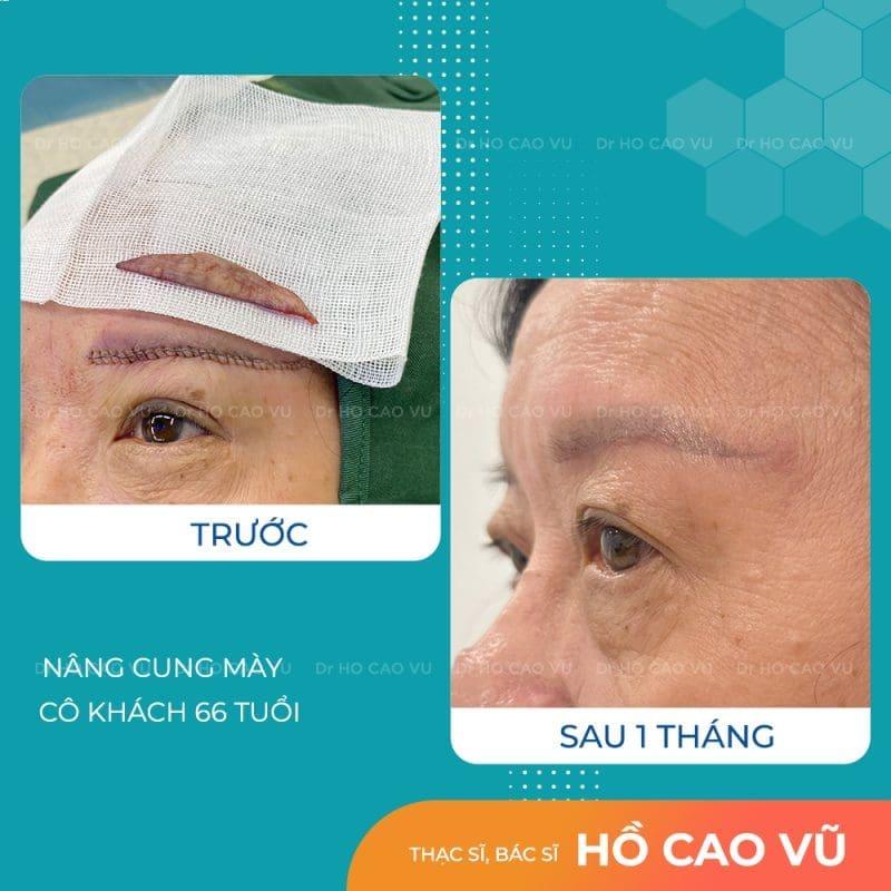 Hình ảnh trước và sau khi nâng cung chân mày