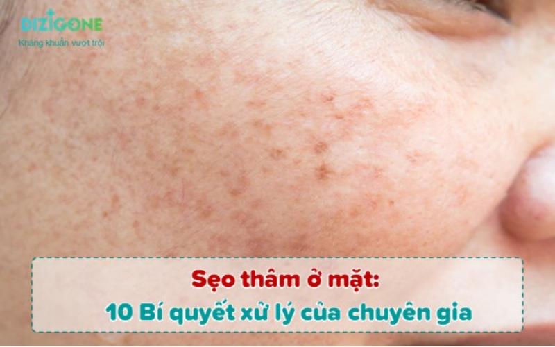 Ngăn Ngừa Sẹo Thâm Ở Mặt