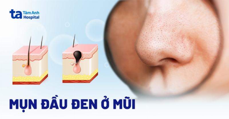 nguyen-nhan-mun-dau-den-o-mui-va-cach-xu-ly-hieu-qua