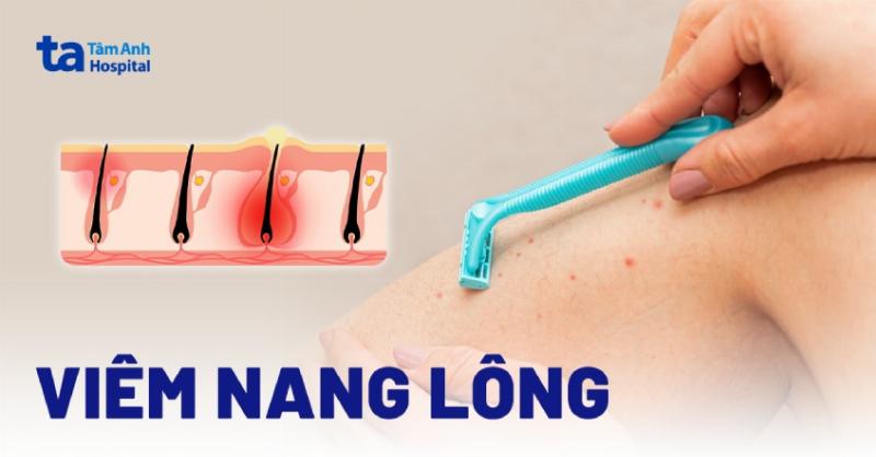 Hình ảnh: Cách phòng ngừa viêm nang lông vùng kín