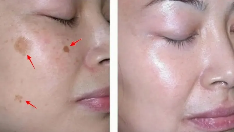 Phương pháp peel da trị nám