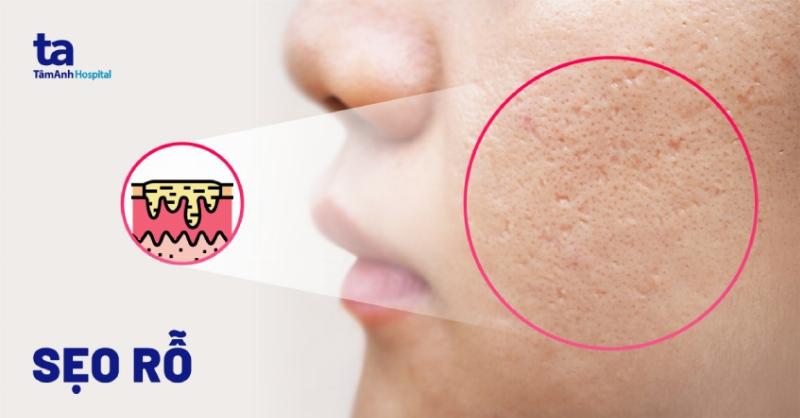 Hình ảnh minh họa các sai lầm phổ biến khi trị thâm mụn như không chống nắng, nặn mụn, dùng quá nhiều sản phẩm, với các biểu tượng cảnh báo