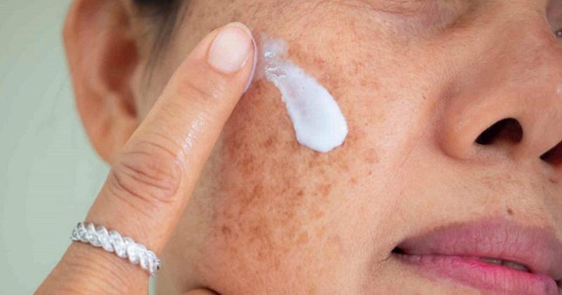 Sử Dụng Kem Trị Nám Chính Hãng Đúng Cách