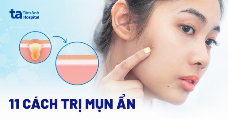 thuoc-tri-mun-chua-benzoyl-peroxide-hieu-qua-cho-lan-da-sach-min