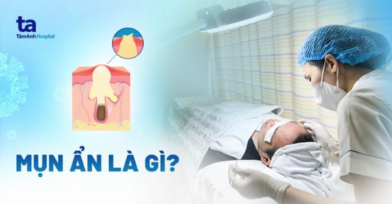 Hình ảnh minh họa các yếu tố sinh hoạt ảnh hưởng đến mụn ẩn: chế độ ăn uống không lành mạnh, stress, thiếu ngủ, và môi trường ô nhiễm