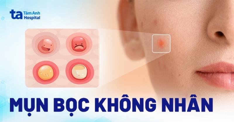 Bác sĩ tư vấn mụn đầu đinh: Hình ảnh mô phỏng bác sĩ da liễu đang tư vấn cho bệnh nhân về cách chăm sóc và điều trị mụn đầu đinh