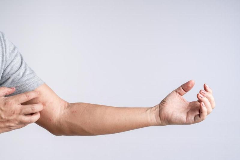 Cận cảnh vết muỗi đốt sưng đỏ trên cánh tay em bé, minh họa vấn đề da liễu thường gặp ở trẻ do muỗi gây ra.