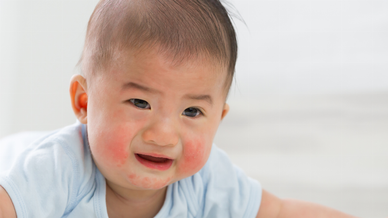 Một bé nhỏ đang gãi vùng da bị mẩn đỏ sau khi dùng xịt muỗi, minh họa phản ứng dị ứng hoặc kích ứng với sản phẩm.