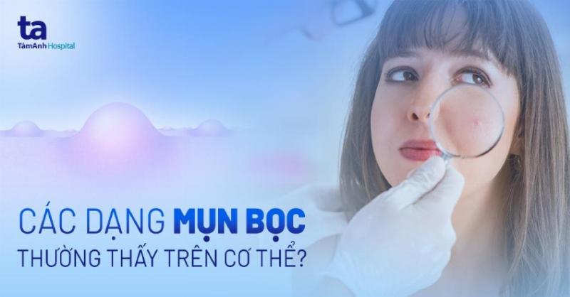 Hình ảnh minh họa các loại mụn không nên nặn như mụn bọc, mụn nang với đặc điểm sưng to, đỏ, nằm sâu dưới da
