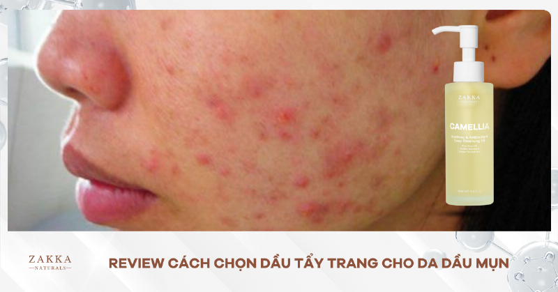 Hướng dẫn chi tiết cách dùng nước tẩy trang cho da dầu mụn hiệu quả