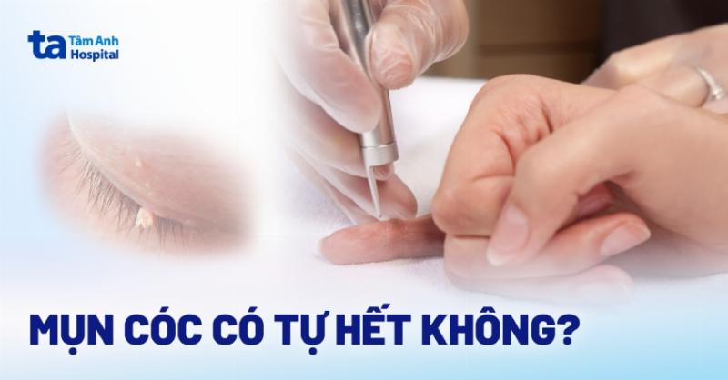 Hình ảnh minh họa cấu tạo các loại đầu phổ biến của cây nặn mụn bao gồm đầu vòng, đầu muỗng và đầu nhọn để người dùng dễ dàng nhận biết