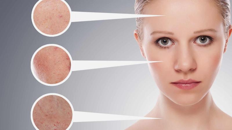 Công dụng tuyệt vời của hạt ngũ hoa trong việc trị mụn, giảm viêm cho da