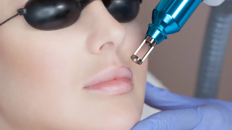 Các phương pháp thẩm mỹ tiên tiến giúp trị thâm viền môi hiệu quả.