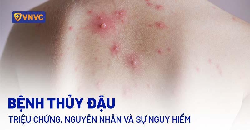 Hình ảnh minh họa các câu hỏi thường gặp về việc nặn mụn và câu trả lời ngắn gọn, trực quan