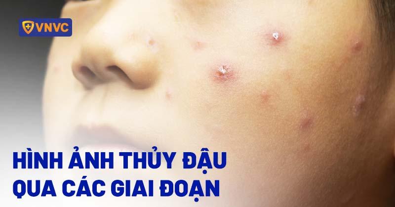Các giai đoạn phát triển của mụn đầu đinh từ sưng đỏ đến hình thành mủ và vỡ