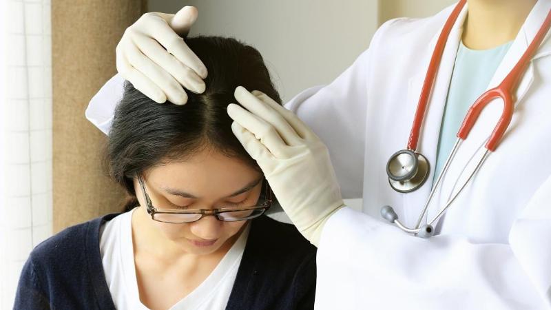 Hình ảnh minh họa da đầu bị gàu và bong tróc do không tẩy da chết da đầu