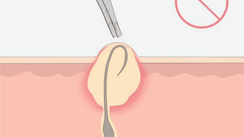 Giải pháp hiệu quả xử lý lông mọc ngược sau khi cạo lông cu