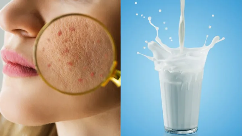 Lợi ích tuyệt vời khi dùng sữa rửa mặt acne đúng cách cho da mụn