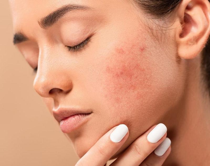 Nốt ruồi trên da, minh họa lý do y tế và thẩm mỹ khiến mọi người muốn xóa nốt ruồi để cải thiện ngoại hình và sức khỏe da