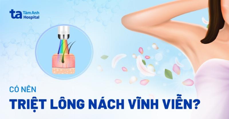 Hình ảnh mô phỏng cách máy triệt lông diode laser hoạt động trên nang lông, tiêu diệt gốc lông