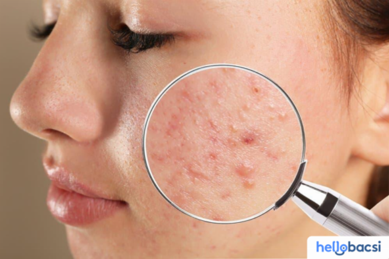 Phân biệt hiện tượng đẩy mụn (purging) và lên mụn (breakout) khi sử dụng Differin