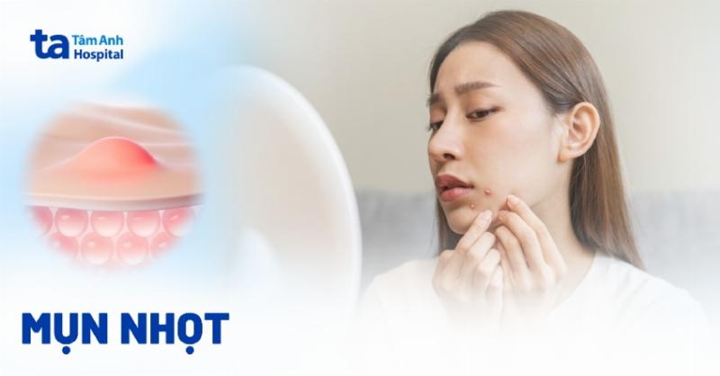 Rạch và dẫn lưu mụn đầu đinh: Quy trình y khoa an toàn để loại bỏ mủ và dịch viêm từ mụn đầu đinh
