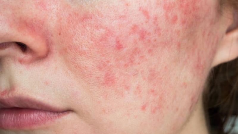 Những sai lầm thường gặp khi sử dụng tẩy trang La Roche-Posay và cách khắc phục