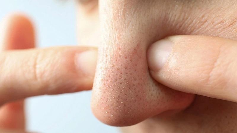 Hinh anh serum Effaclar La Roche Posay dac tri mun an mun dau den va tham