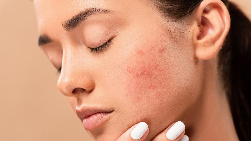 So sánh Adapalene 0.1 với Benzoyl Peroxide và BHA