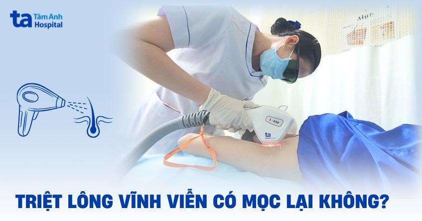 So sánh các công nghệ triệt lông phổ biến như Laser và IPL để bạn lựa chọn dịch vụ triệt lông Hà Nội phù hợp nhất