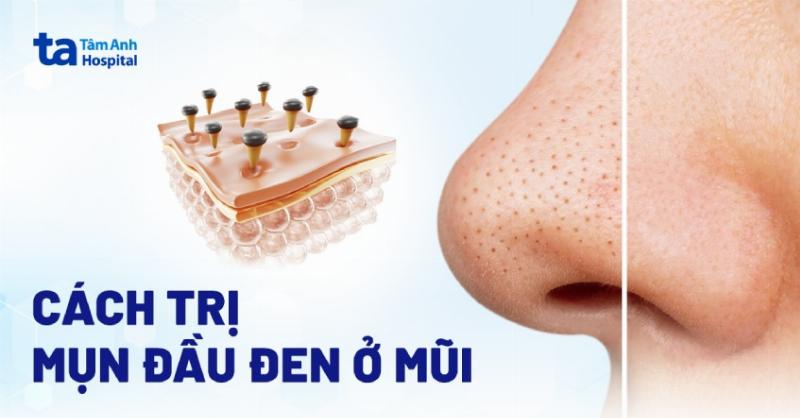 Hình ảnh so sánh hiệu quả các phương pháp trị mụn đầu đen khác nhau, bao gồm lột mụn và các cách khác