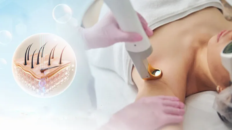 Hình ảnh đồ họa so sánh các phương pháp triệt lông khác nhau (cạo, wax, laser), nêu bật ưu điểm của Diode Laser.