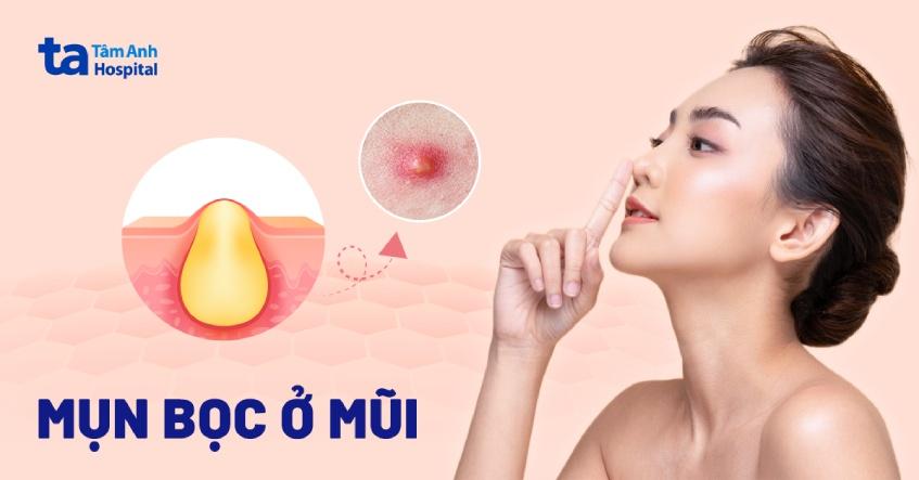 Hình ảnh minh họa thời điểm lý tưởng để trị sẹo lõm, nhấn mạnh da đã sạch mụn viêm và sẵn sàng cho điều trị.