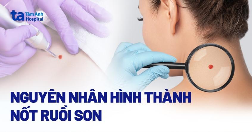 So do minh hoa cac vi tri not ruoi o mieng va y nghia theo tuong so