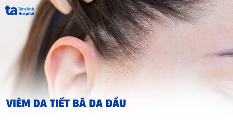 Dấu hiệu nhận biết viêm da tiết bã ở đầu: ngứa, đỏ, vảy da, nhờn da đầu là các triệu chứng thường gặp cần chú ý.