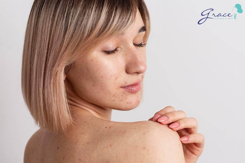 Minh họa sẹo thâm mụn lưng và liệu xà phòng có tác dụng trị sẹo không