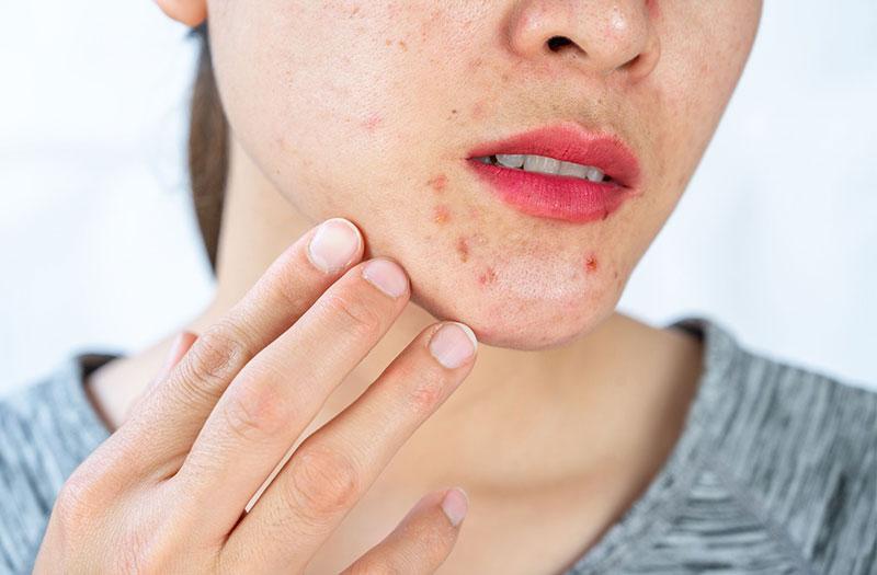 Cách Lấy Nhân Mụn An Toàn Tại Nhà