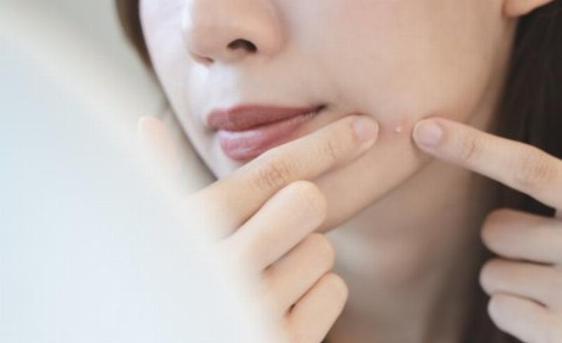 Sản Phẩm Hỗ Trợ Sau Khi Lấy Nhân Mụn