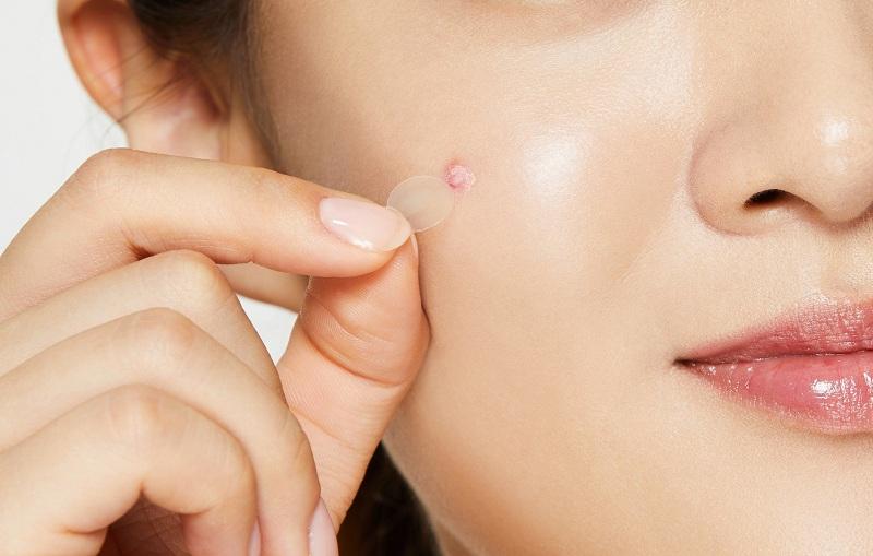 Một người chia sẻ kinh nghiệm thực tế và kết quả sau khi sử dụng miếng dán mụn Derma Angel.