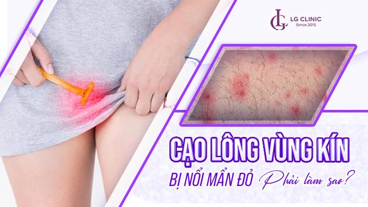 Minh họa hoặc biểu tượng các sai lầm phổ biến khi cạo lông vùng kín tại nhà, như dùng dao cùn, cạo khô, ấn mạnh.